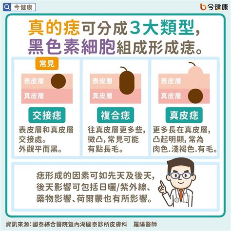 臉頰長痣代表什麼|是痣or皮膚癌？醫「1張圖秒對照」 長這2部位最危險